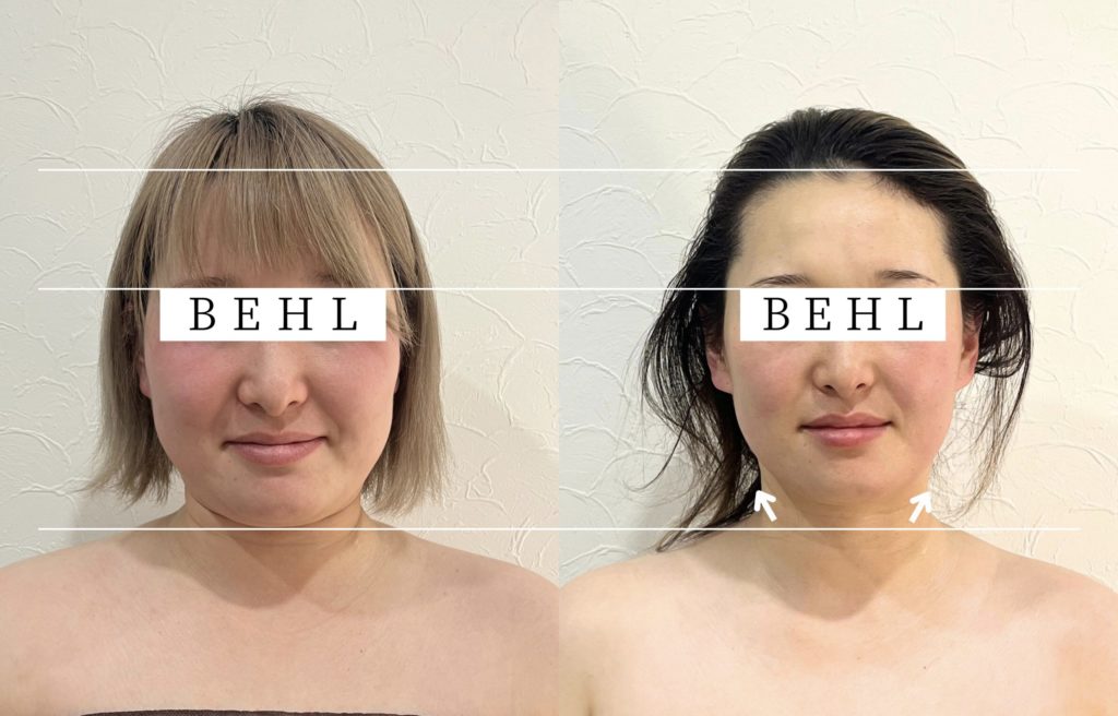 30代女性。首のリンパの詰まり、側頭筋(側頭部)のハリが特に気になる
小顔になりたい、エラの張り、二重あごの改善と首肩こりも気になる
施術メニューBEHL 小顔矯正 コルギ
施術期間3ヶ月(6回の施術)