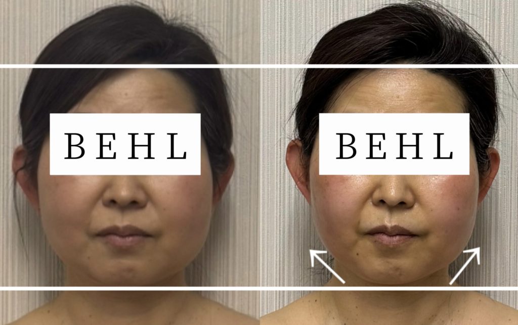 50代日高市出身女性。年齢とともに”たるみ”が気になり、フェイスラインがはっきりしなくなった。
浮腫みやすくなり、顔が大きく感じる
施術メニュー
BEHL 小顔矯正 コルギ
施術期間2ヶ月(4回の施術)