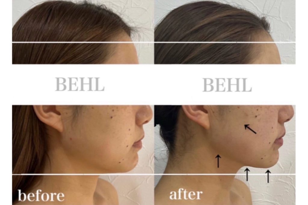 小顔コルギ施術のビフォーアフター。日本人女性の横顔で、beforeはフェイスラインがもたついているが、afterでは顎下がすっきりして輪郭がシャープになっている。