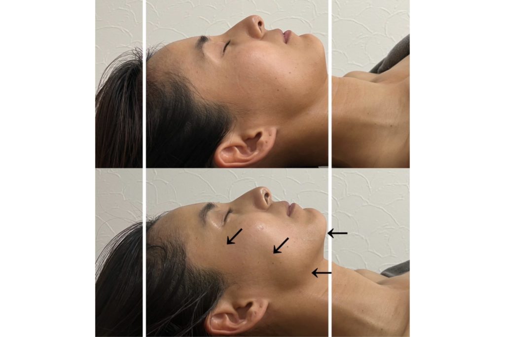 小顔コルギ施術のビフォーアフター。仰向けの日本人女性で、beforeはフェイスラインに厚みがあるが、afterでは頬から顎にかけてリフトアップし、ラインが引き締まっている。