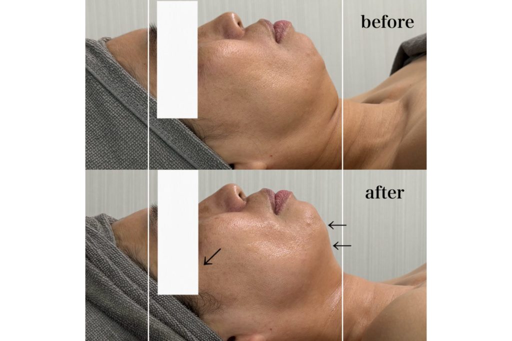 たるみ改善のビフォーアフター。施術前は頬や口角が下がって老けて見えるが、施術後はリフトアップされ若々しい印象に変化。